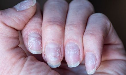 Masalah Kuku Yang Sering Terjadi Dan Cara Mengatasinya