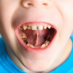 Dampak Gigi Berlubang Pada Anak Dan Cara Mengatasinya