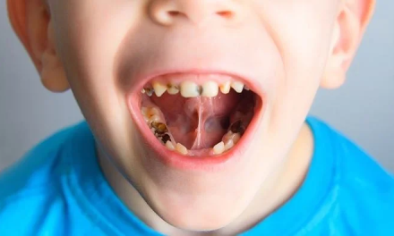 Dampak Gigi Berlubang Pada Anak Dan Cara Mengatasinya