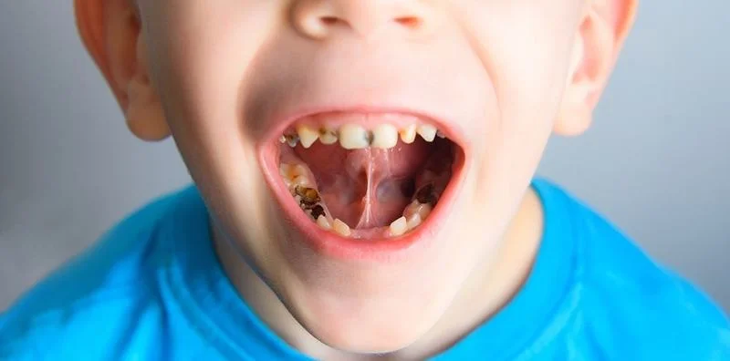 Dampak Gigi Berlubang Pada Anak Dan Cara Mengatasinya